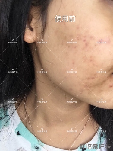 痘花妹變無暇美女