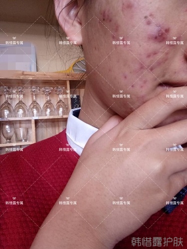 臉上長痘痘怎么去掉？徹底告別痘痘，自卑到自信的蛻變！