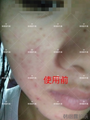 額頭長痘臉頰長痘痘粉刺,這樣調理幫你恢復嫩白肌膚!