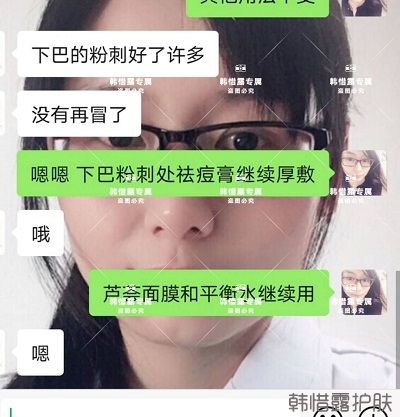 閉口粉刺怎么去除，下巴粉刺好了許多，粉刺沒有再長了