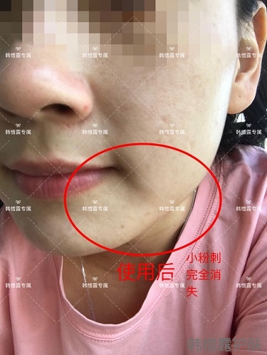 粉刺密密麻麻，試過很多方法無果后找韓惜露老師輕松去掉粉刺！