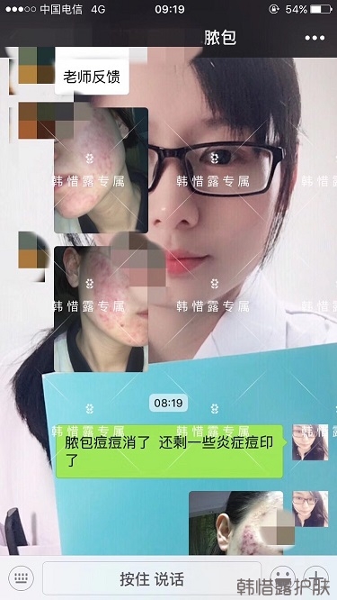 膿包痘痘好了，從慘不忍睹到變美變漂亮