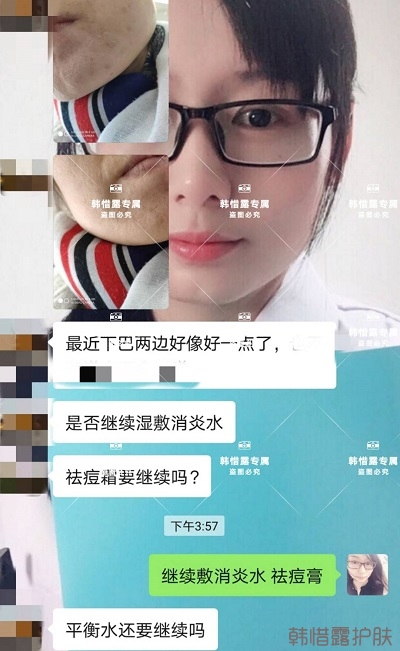 怎么消除臉上的痘痘,發硬膿包消下去了