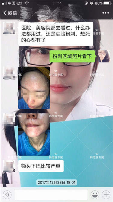 【視頻】臉上長粉刺怎樣去掉？醫(yī)院都沒搞定韓惜露幫我搞定了，超級開心！