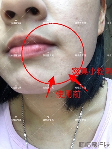 粉刺密密麻麻，試過很多方法無果后找韓惜露老師輕松去掉粉刺！
