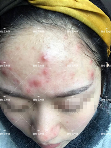 【視頻】臉上長粉刺怎樣去掉？醫(yī)院都沒搞定韓惜露幫我搞定了，超級開心！