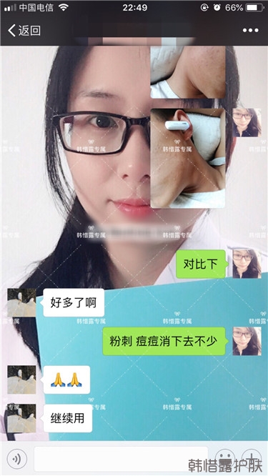 粉刺消了，皮膚光滑了，變帥氣不少呦！