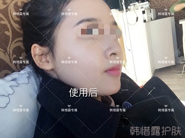 痘花妹變無暇美女