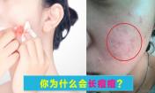 臉上長痘痘是什么原因?請問主要是什么原因呢?