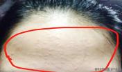 怎么才能去掉閉口痘痘呢?