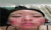 【祛痘視頻反饋】激素臉長痘20多年，大膿包，發癢，完全恢復！