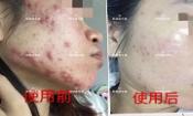 下巴長(zhǎng)痘怎么辦?膿包痘祛痘效果,擁有干凈的臉不等待!